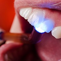 Blue dental light used for cosmetic bonding.