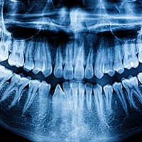Dental X-Ray