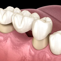 traditional dental bridge replacing a missing tooth