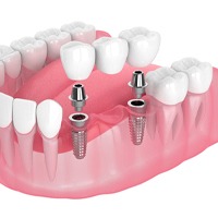 two dental implants supporting a dental bridge