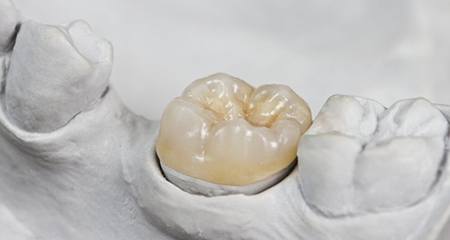 A dental crown sitting in a mold.