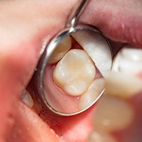 A closeup of a dental crown inside of a mouth.