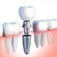 Animation of implant supported crown
