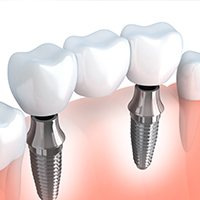 Animation of implant supported bridge