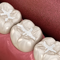 Close-up of tooth-colored fillings in Bellevue, WA on three teeth