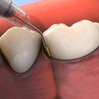 Damaged teeth and gums receiving treatment