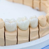 Model smile with fixed bridge restoration