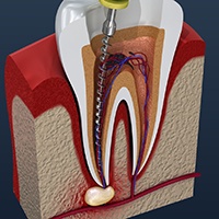 Illustration of dental instrument being used during root canal therapy